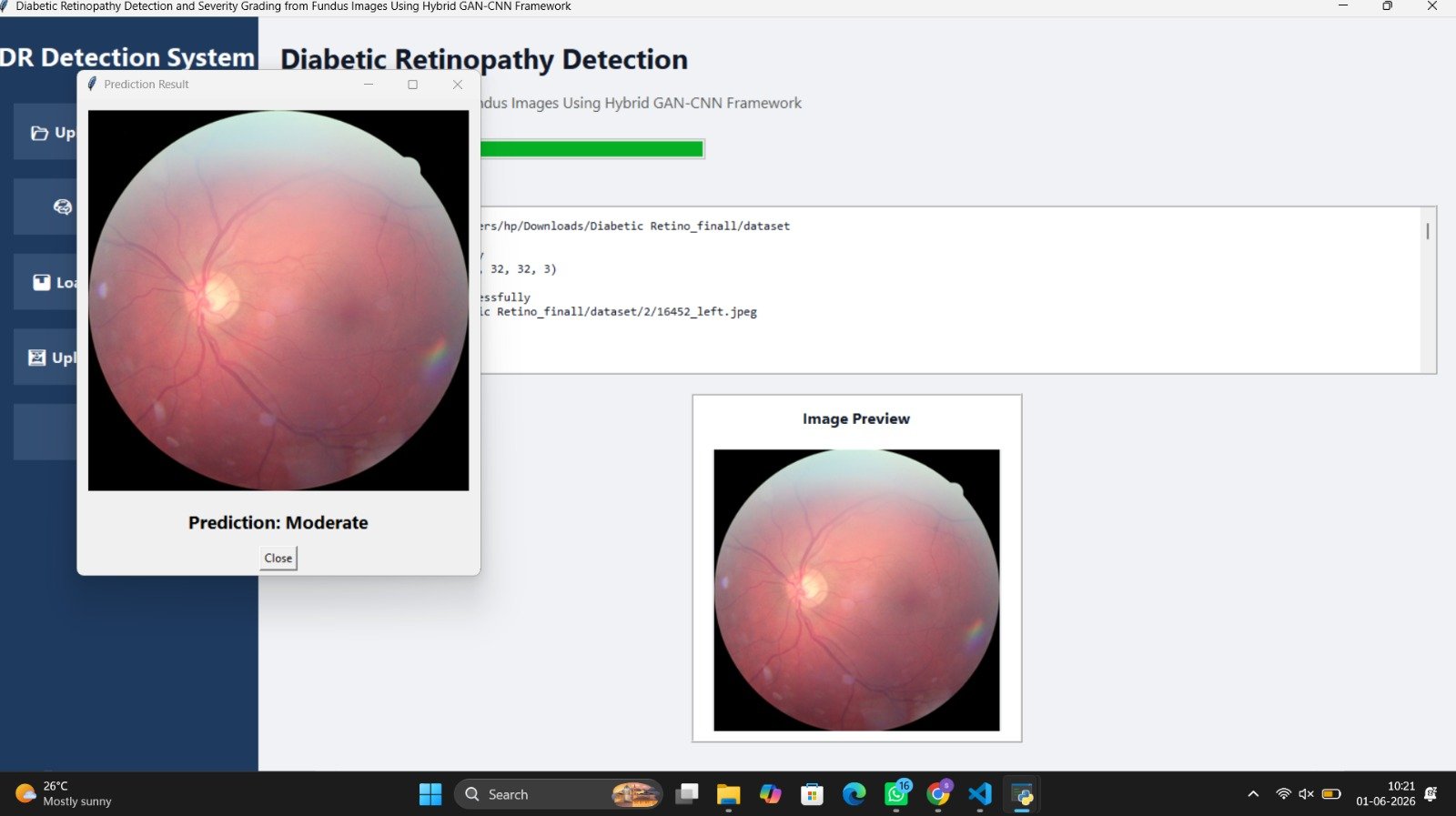 Diabetic Retinopathy Detection Using Hybrid GAN CNN Framework